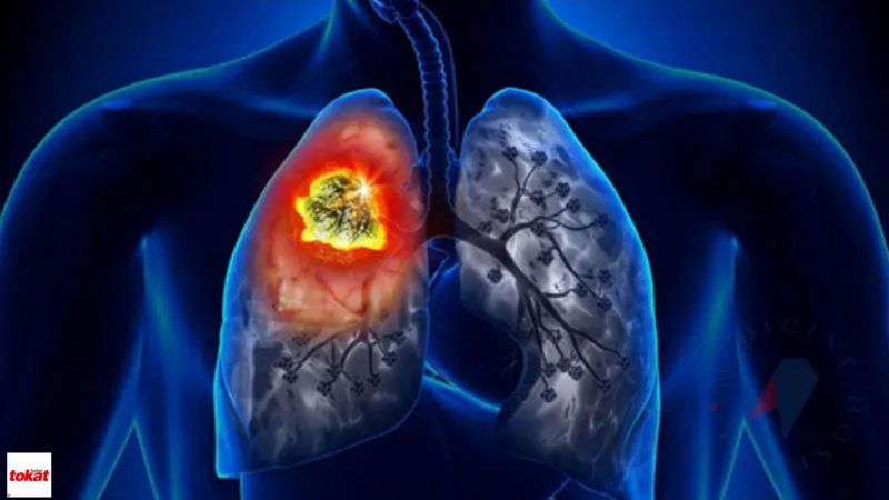 Akciğer kanseri sigara içmeyenlerde de görülüyor